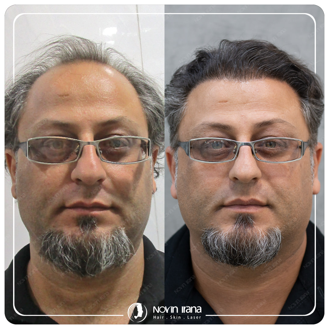 Hair Transplant