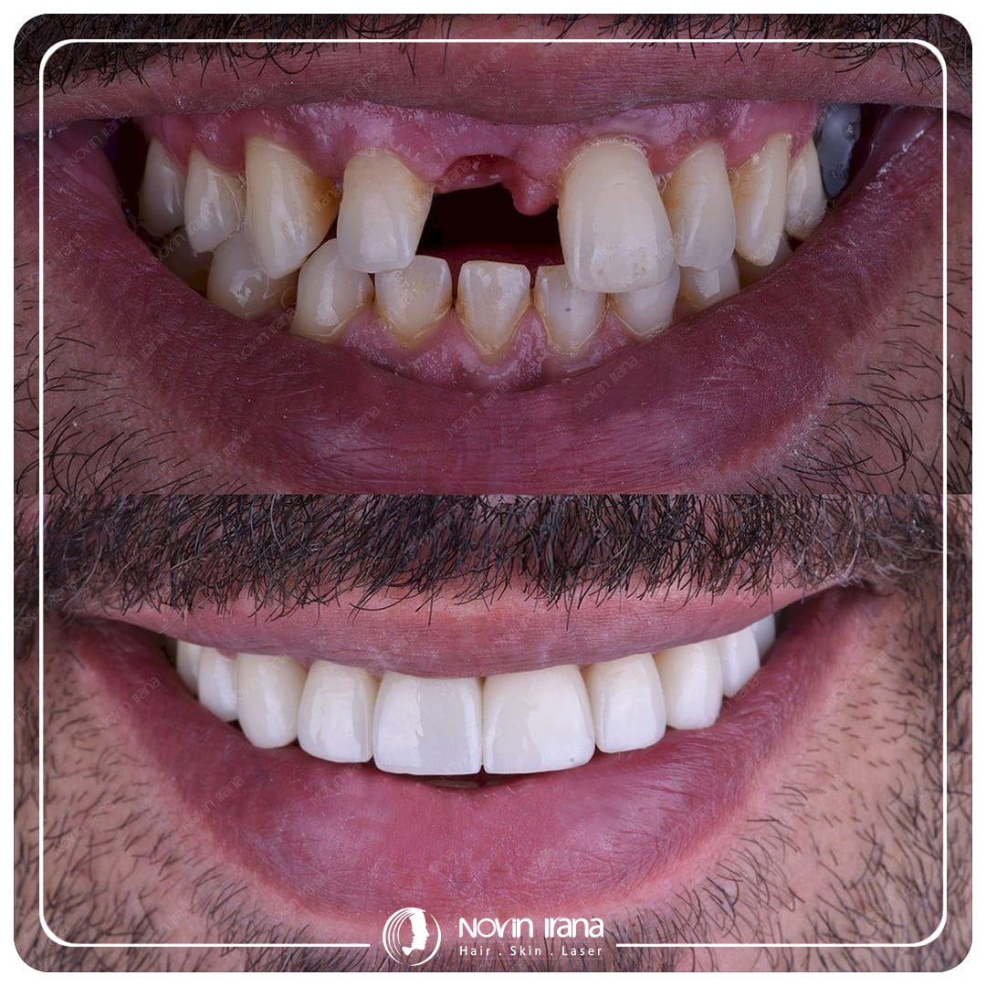 Hollywood smile
