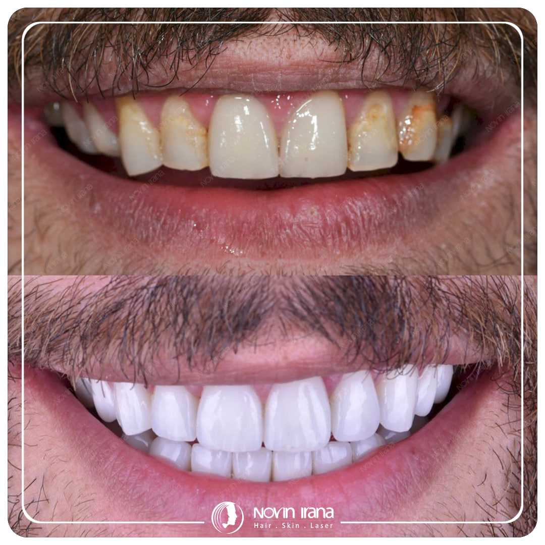 Hollywood smile