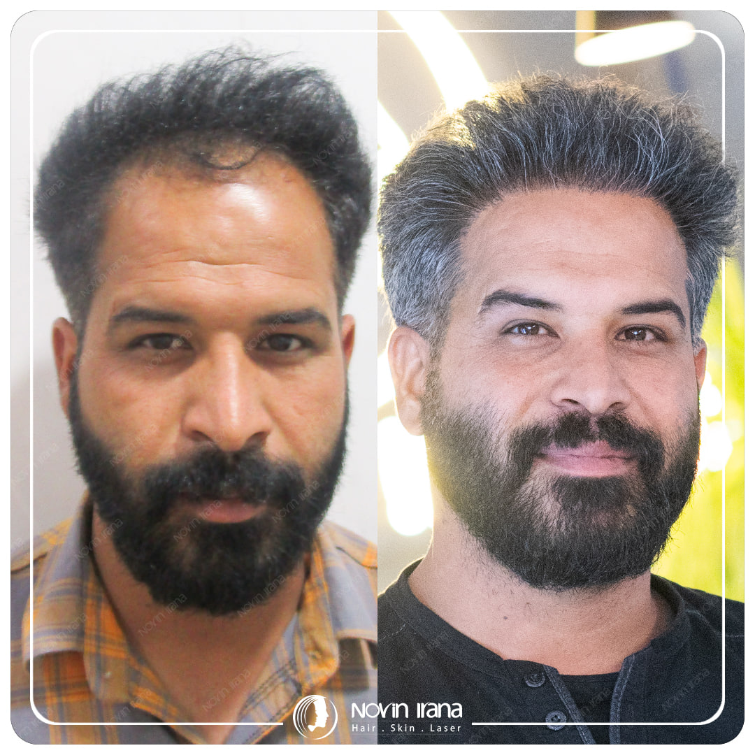 Hair Transplant