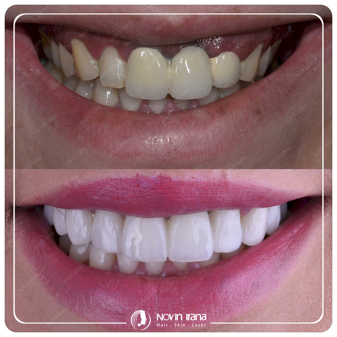 Hollywood smile