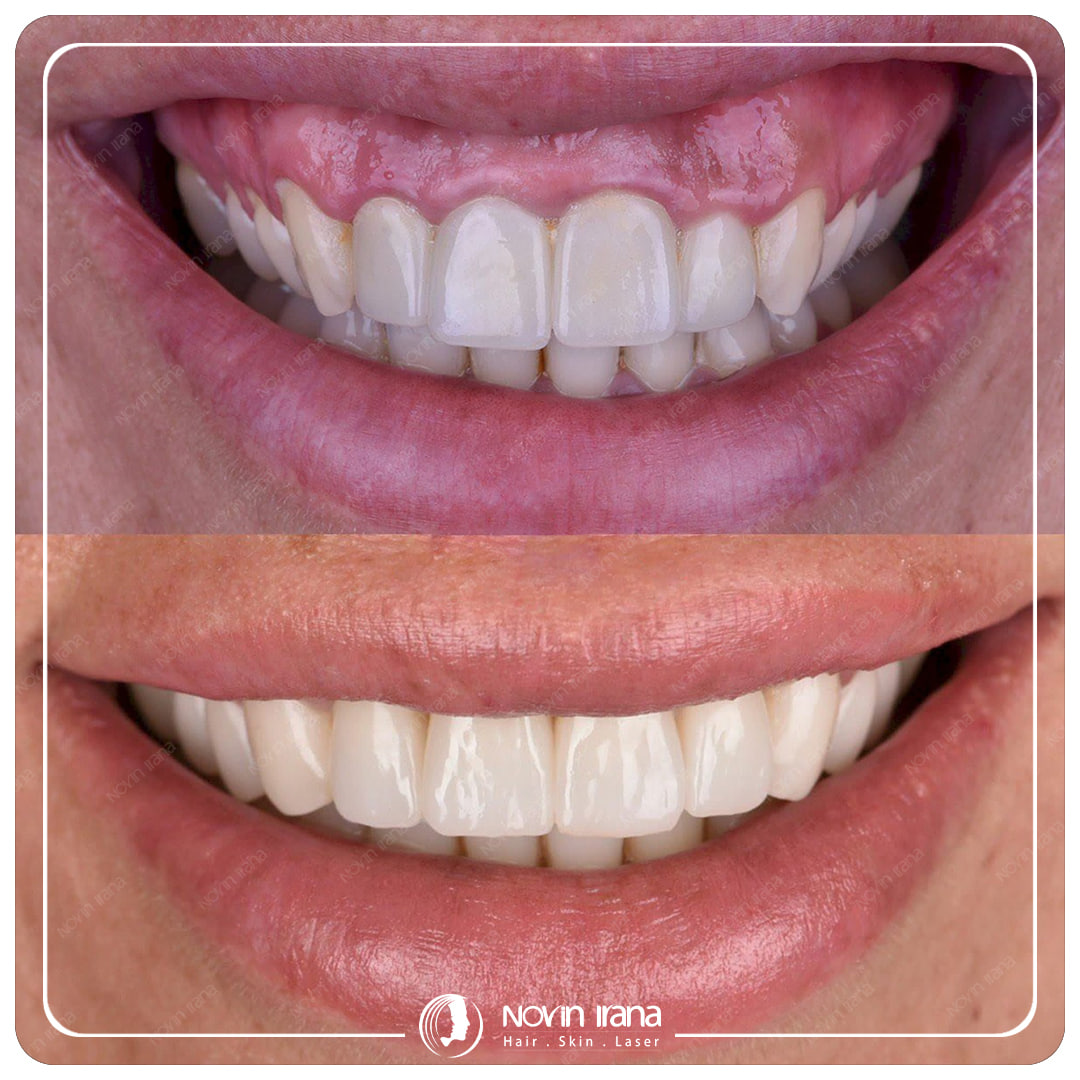 Hollywood smile