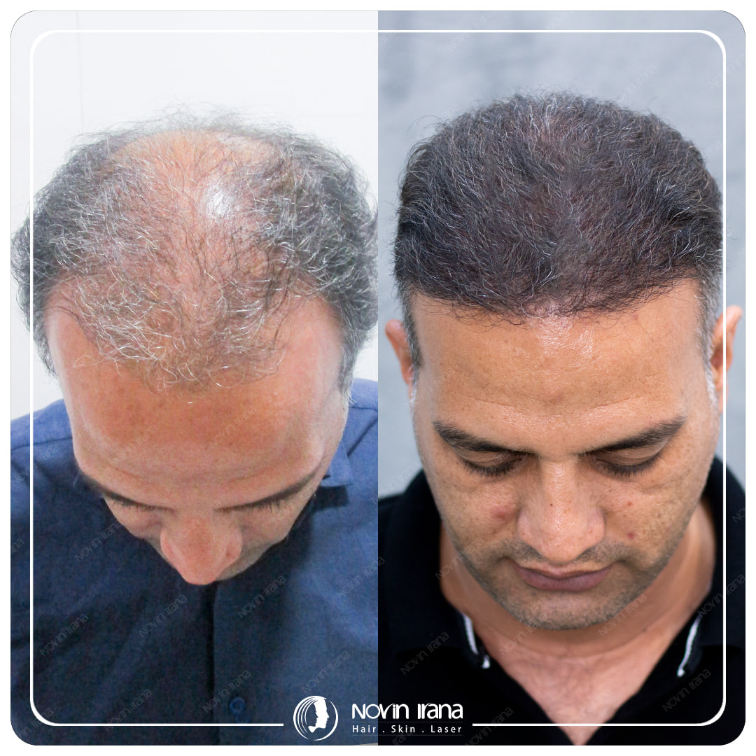 Hair Transplant