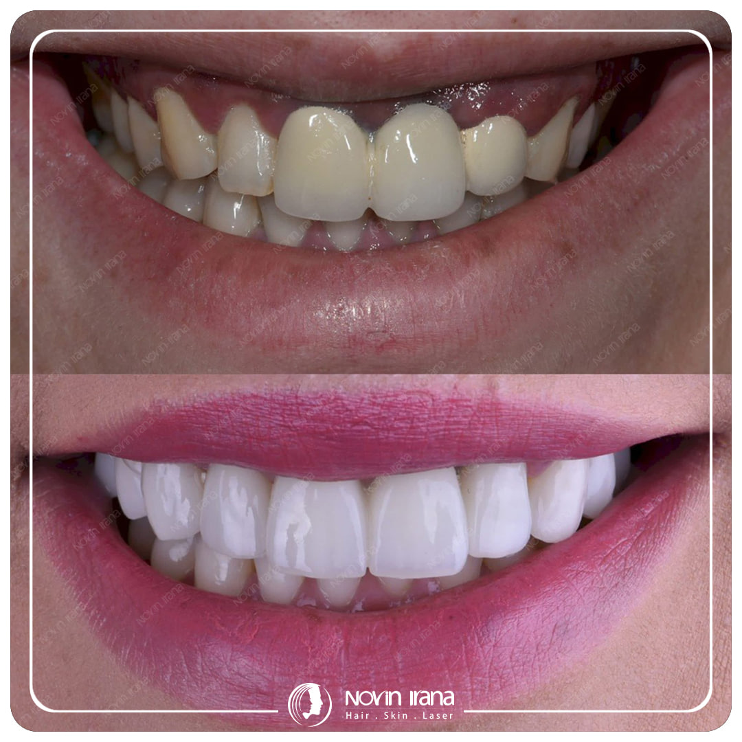 Hollywood smile