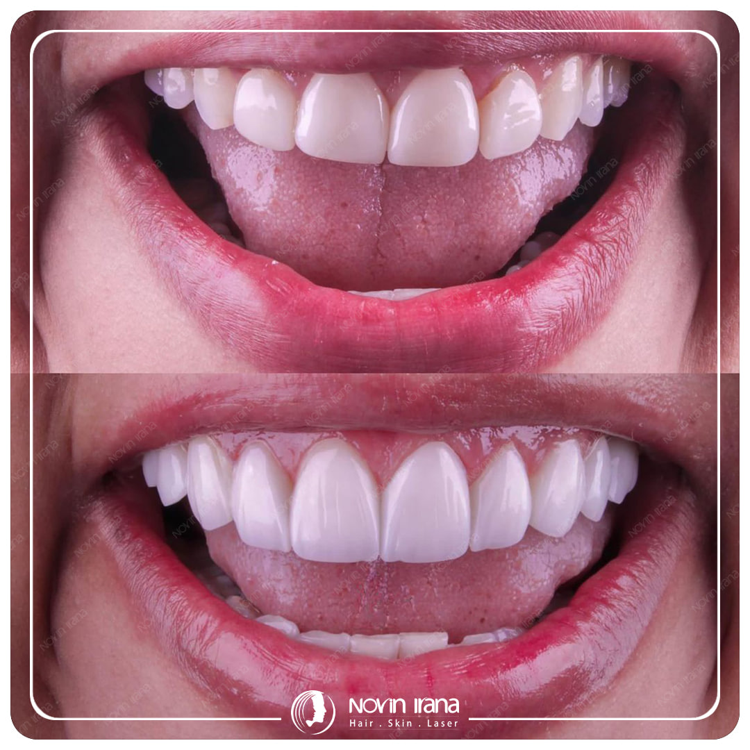 Hollywood smile