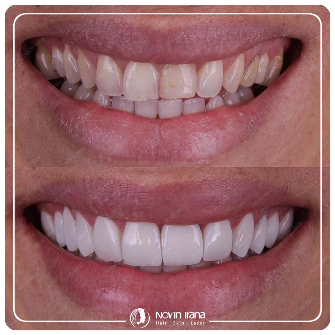Hollywood smile