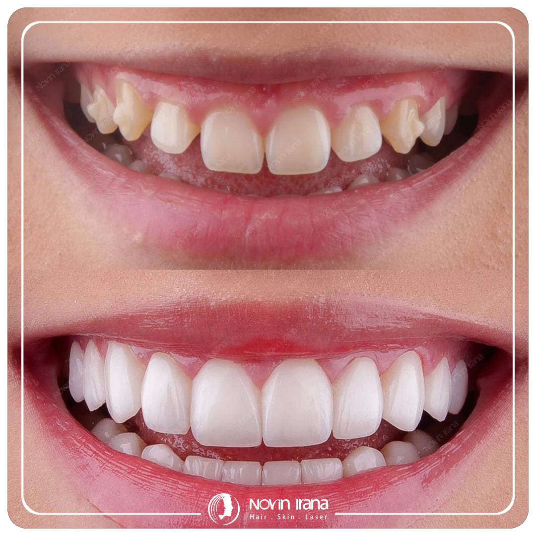Hollywood smile