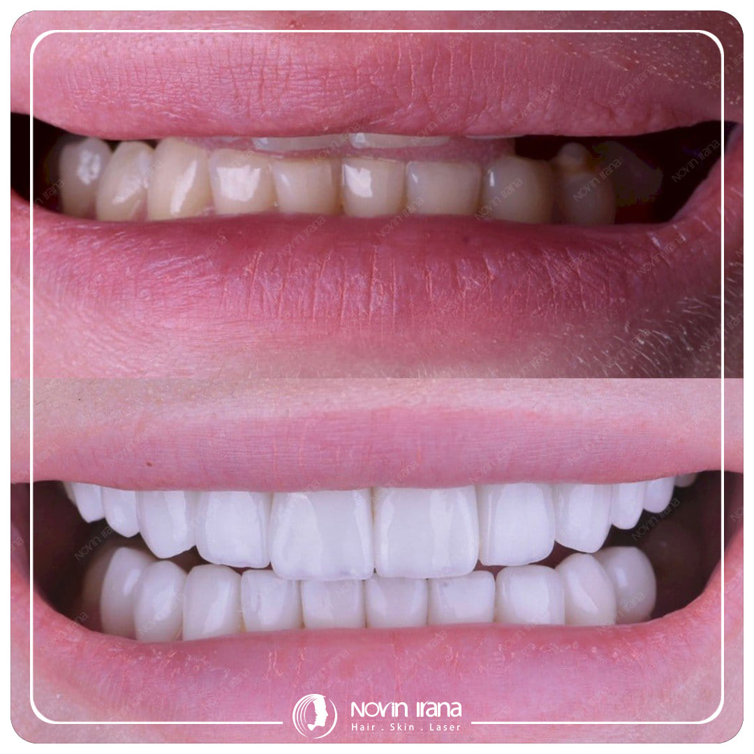Hollywood smile