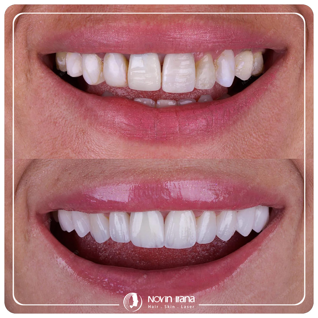 Hollywood smile