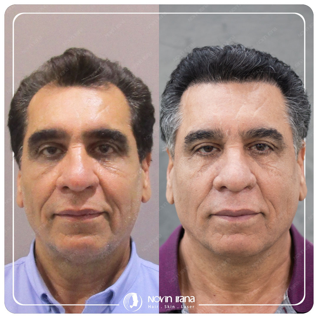 Hair Transplant