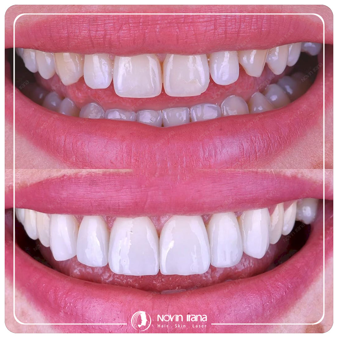 Hollywood smile
