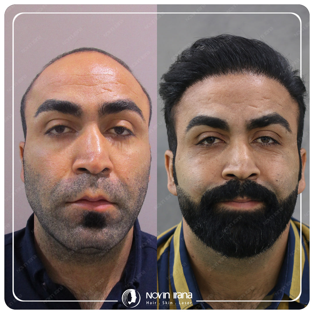 Hair Transplant