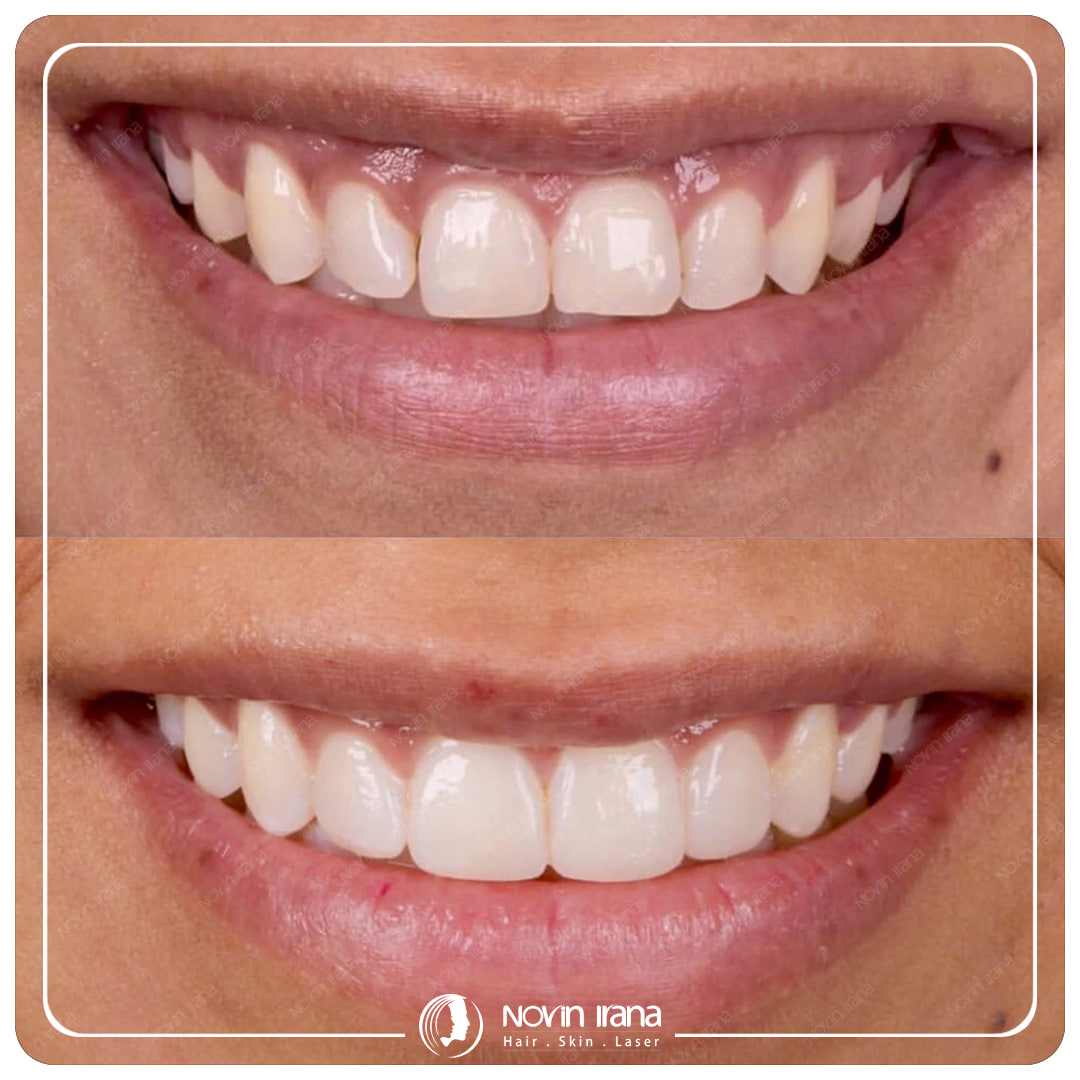 Hollywood smile