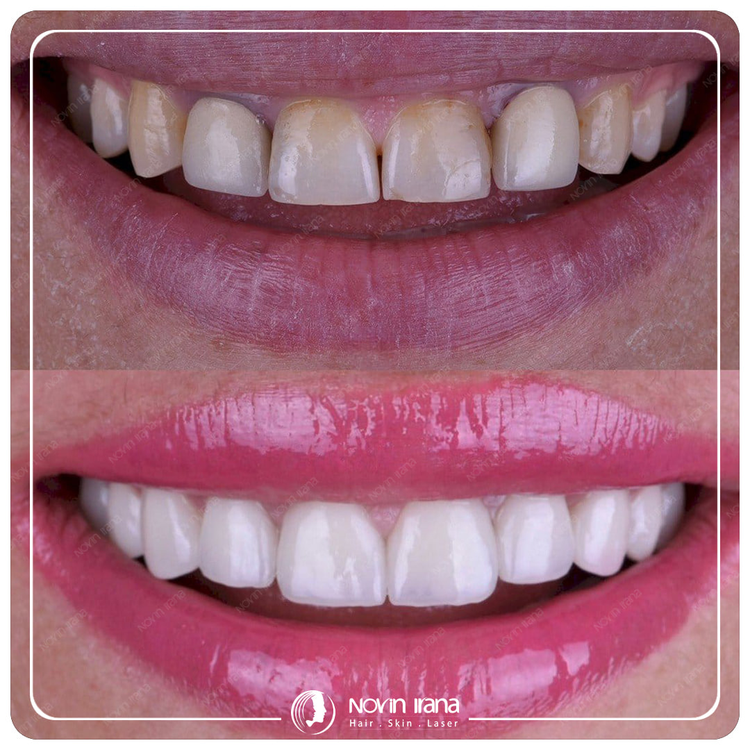 Hollywood smile
