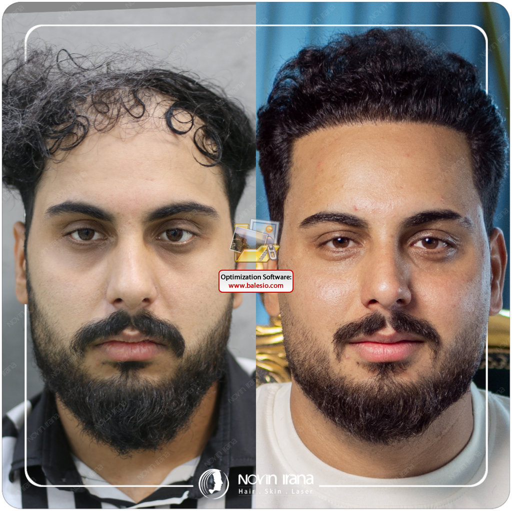 Hair Transplant