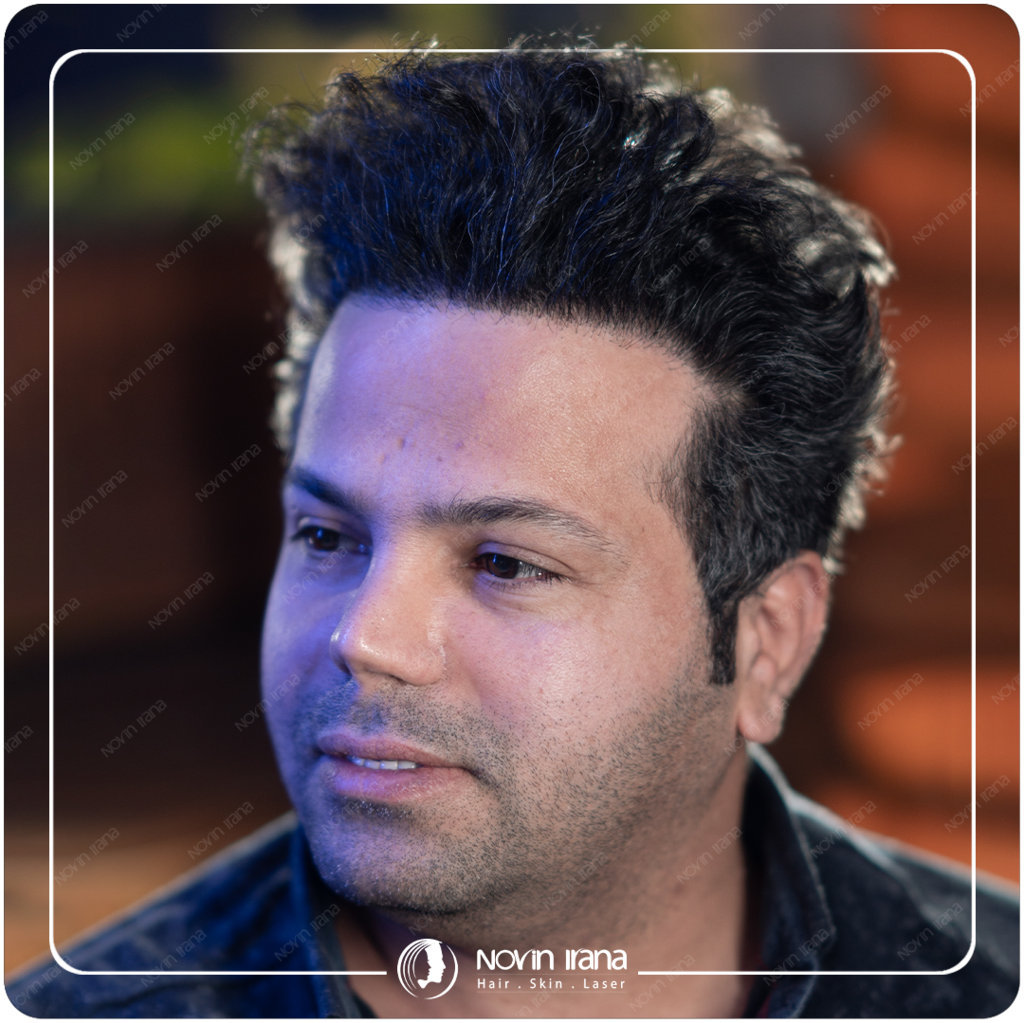 زراعة الشعر