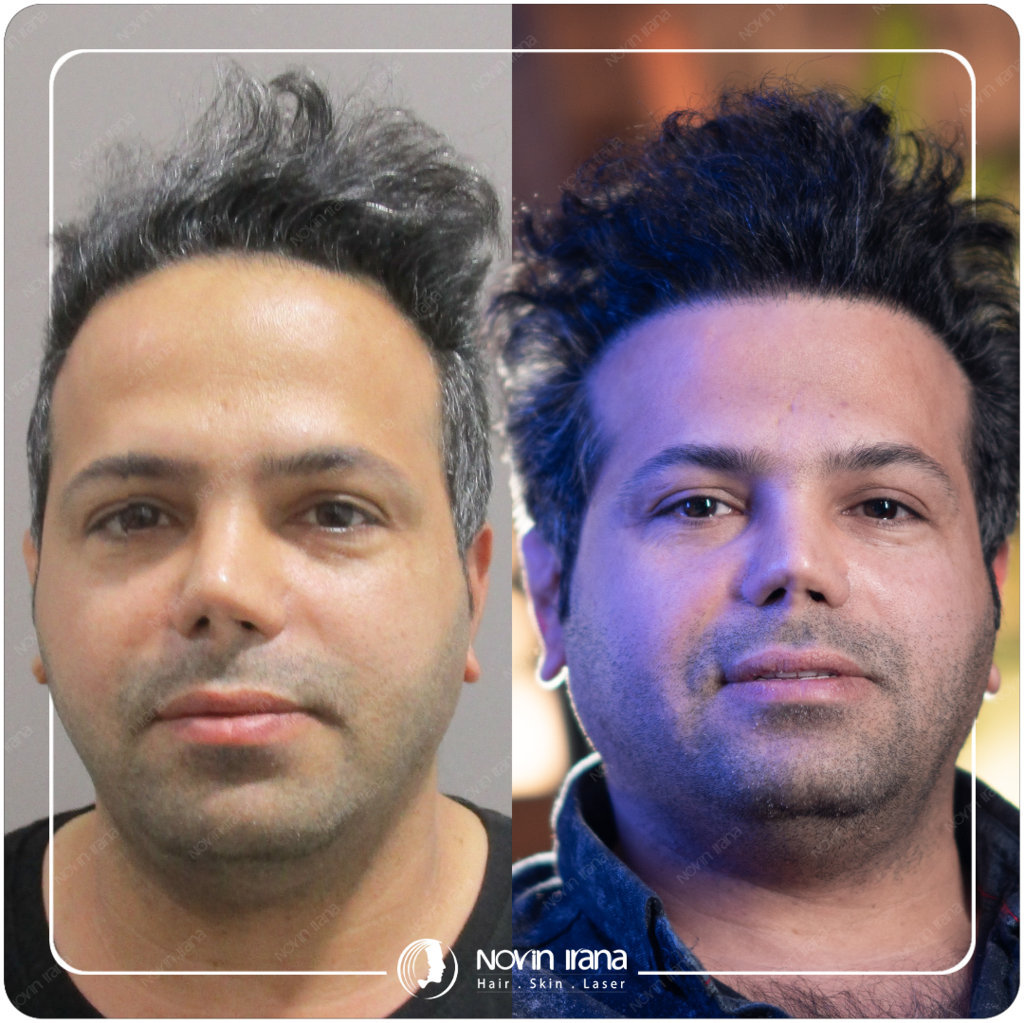 Hair Transplant