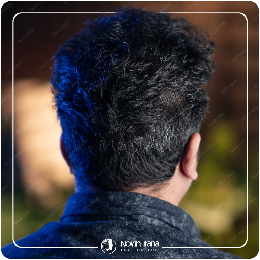 Hair Transplant