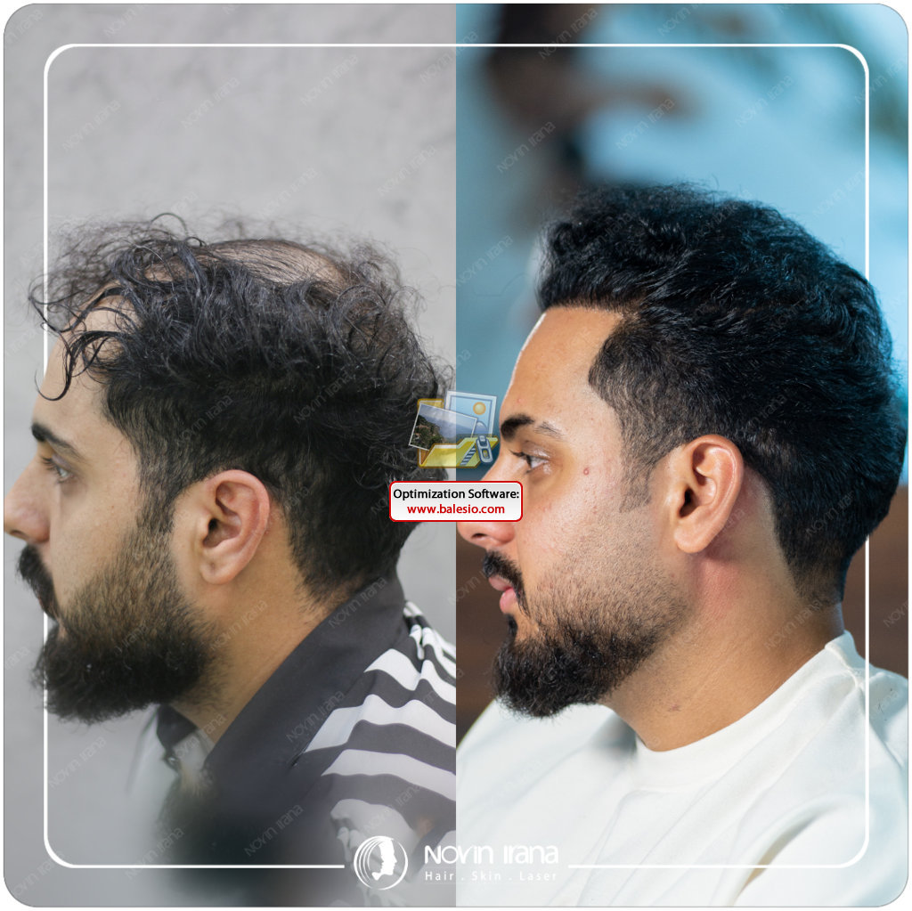 Hair Transplant