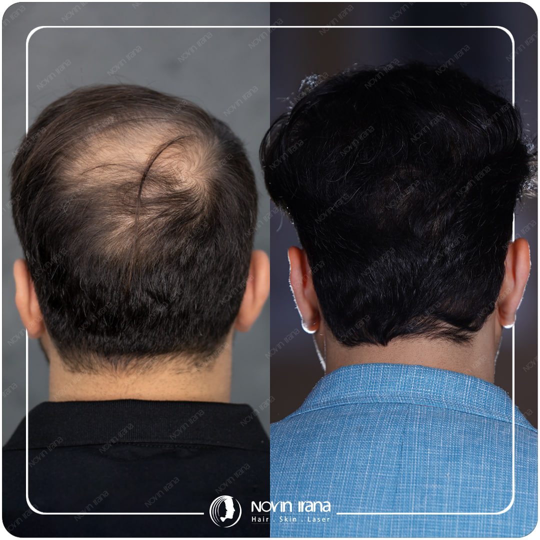 زراعة الشعر