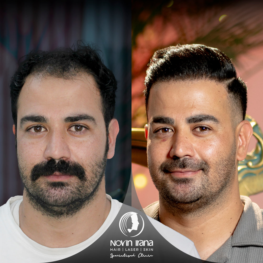 Hair Transplant
