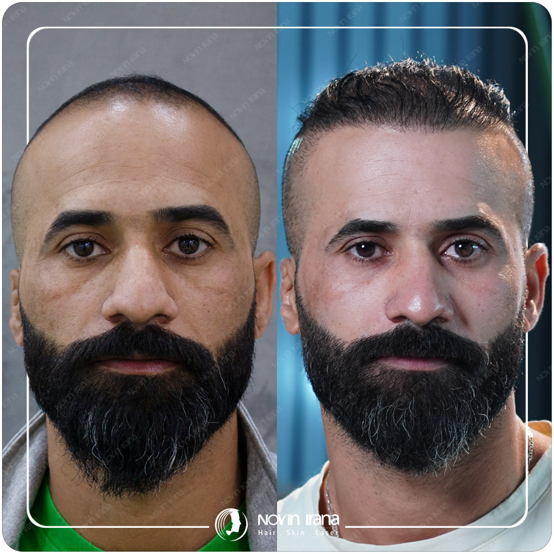 Hair Transplant