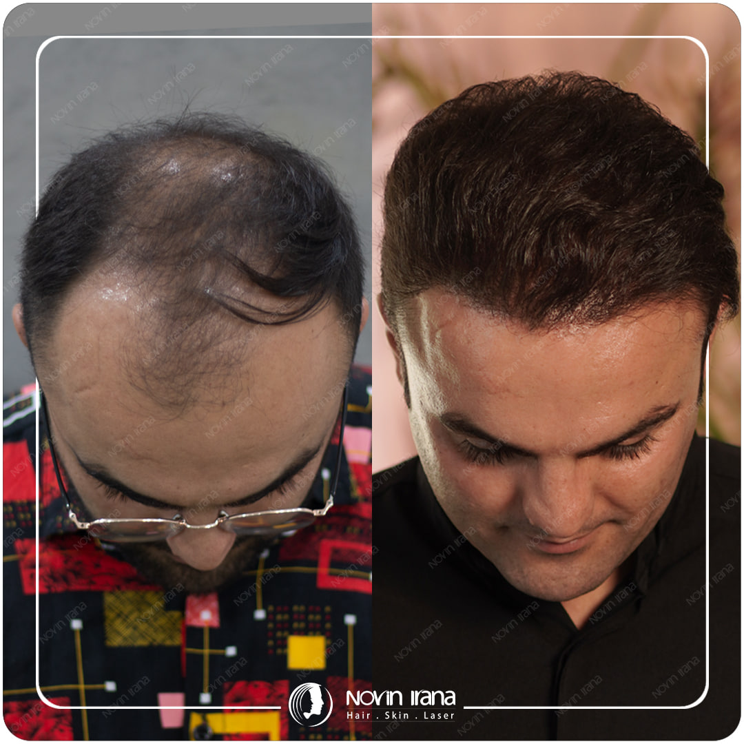 Hair Transplant