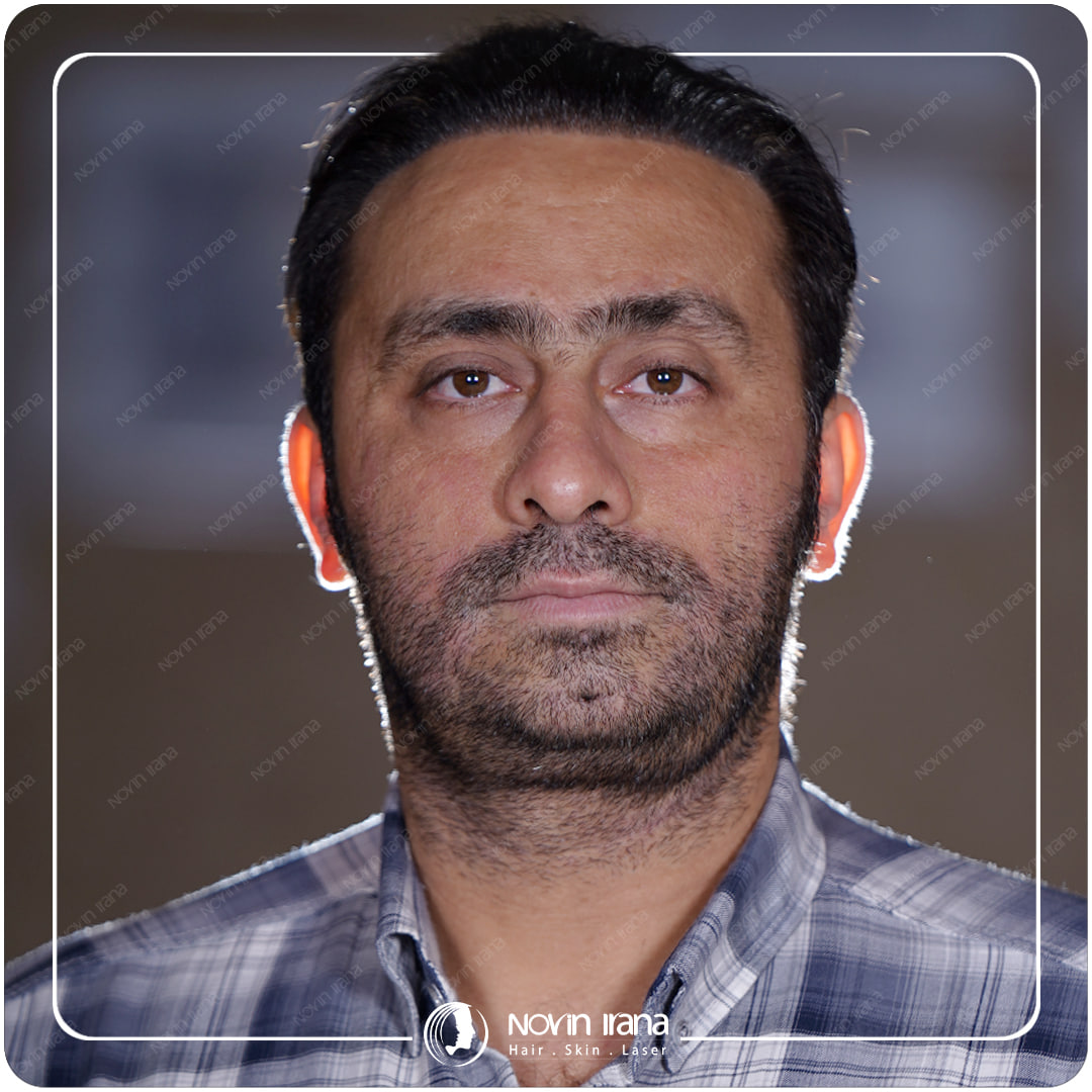 زراعة الشعر