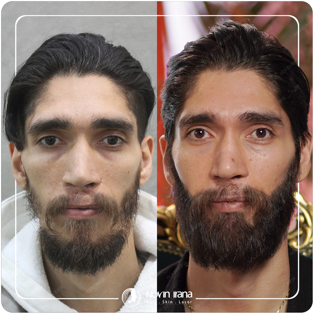 زراعة الشعر