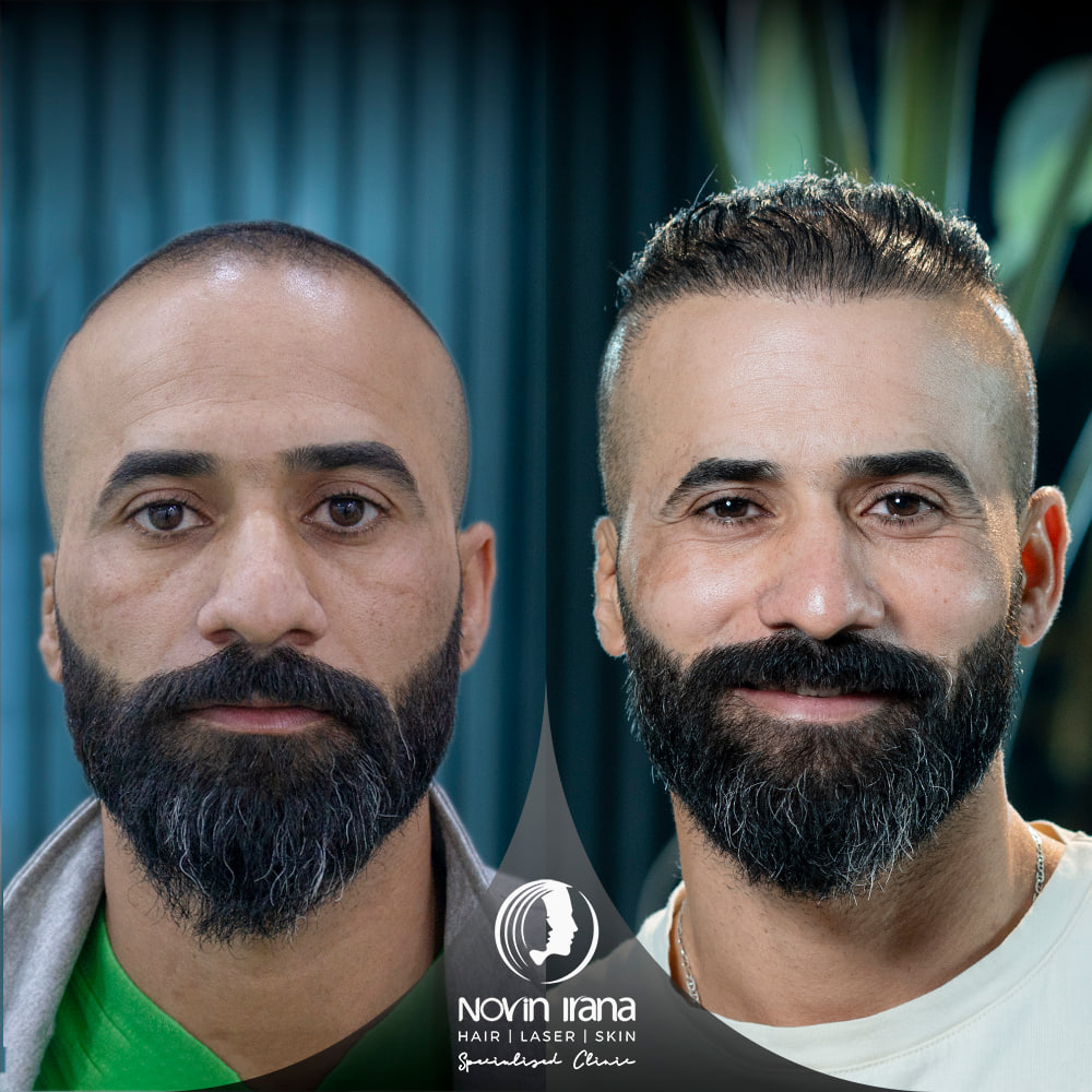 زراعة الشعر