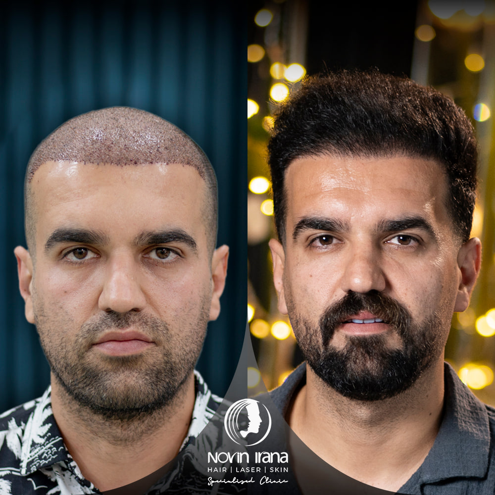Hair Transplant