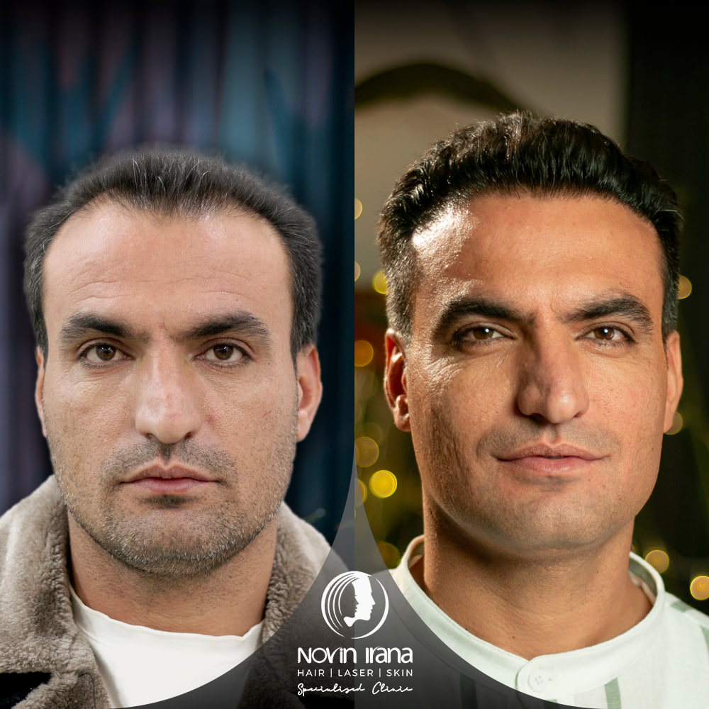 Hair Transplant