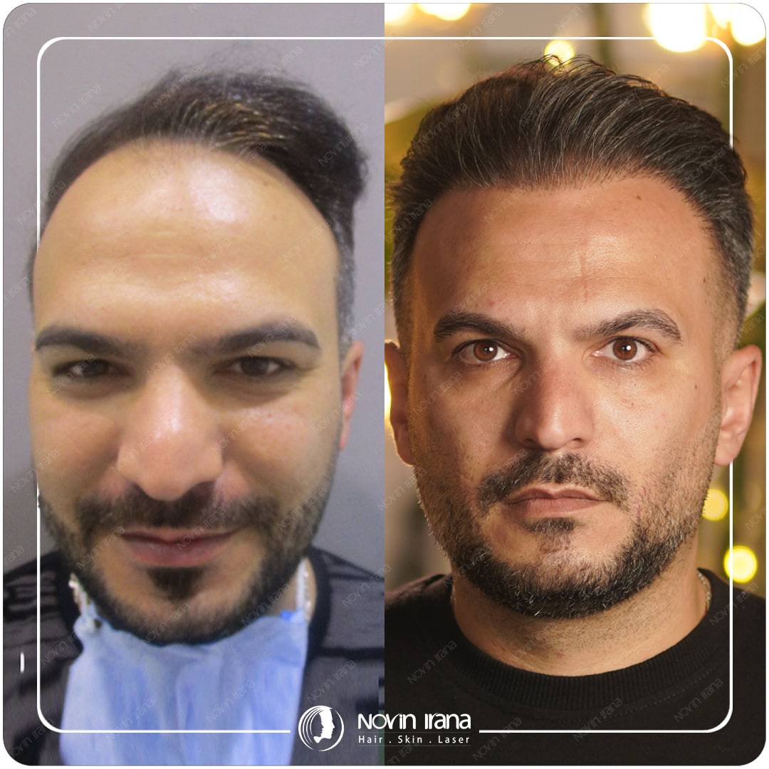 Hair Transplant