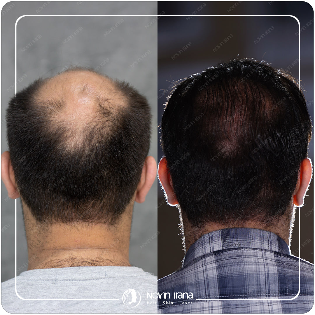 Hair Transplant