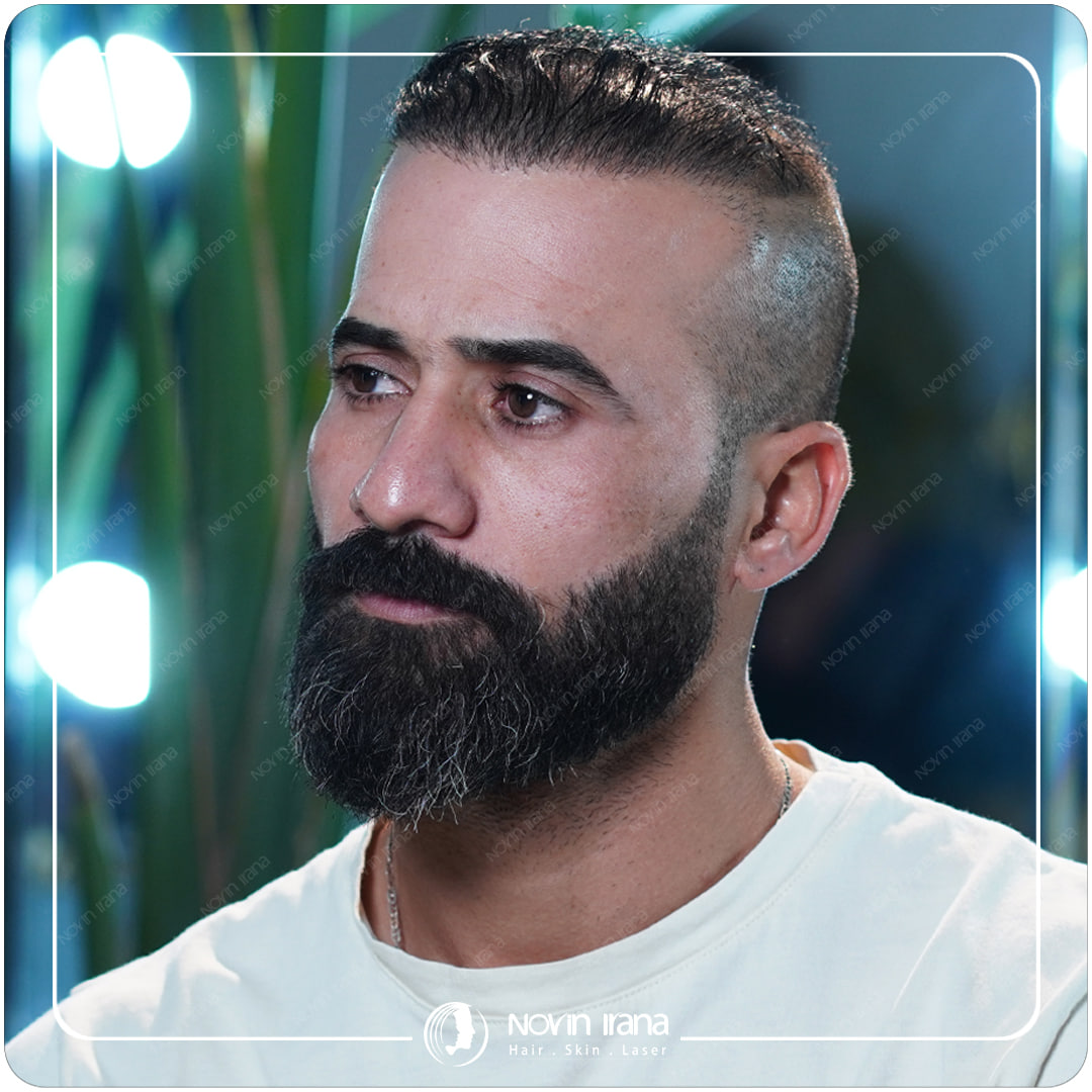 زراعة الشعر