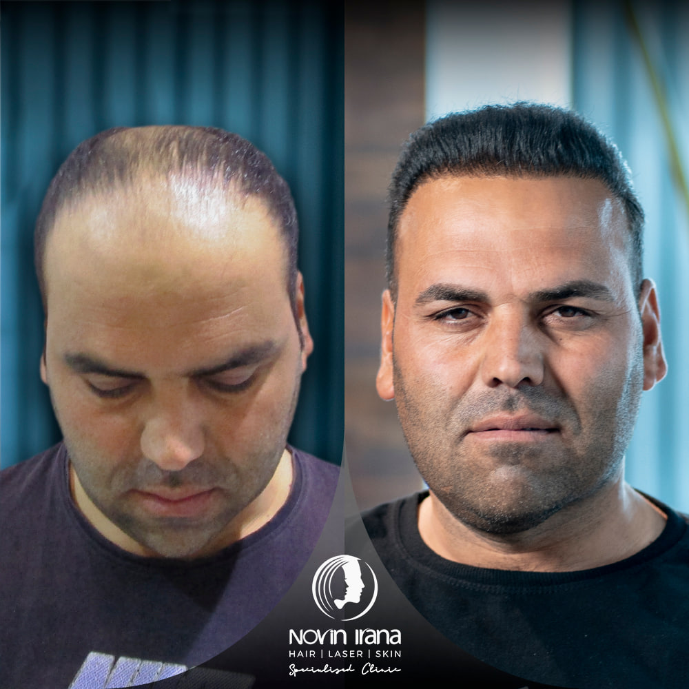 Hair Transplant