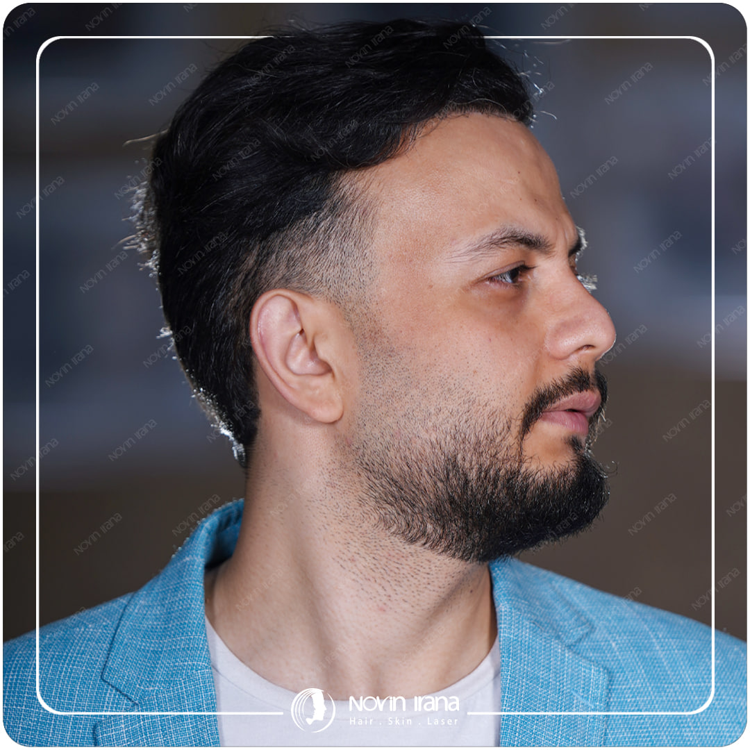 Hair Transplant