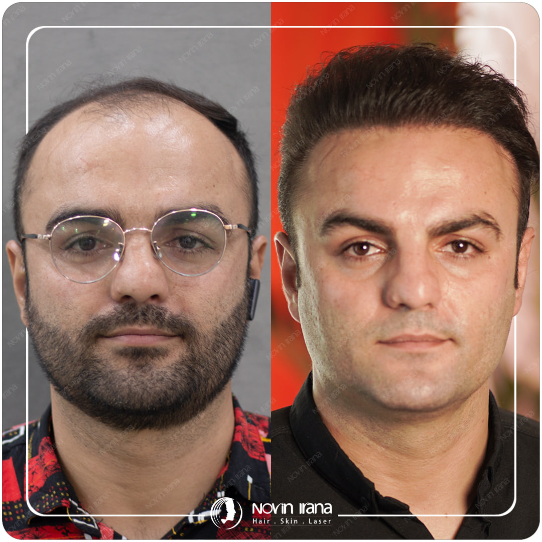 Hair Transplant