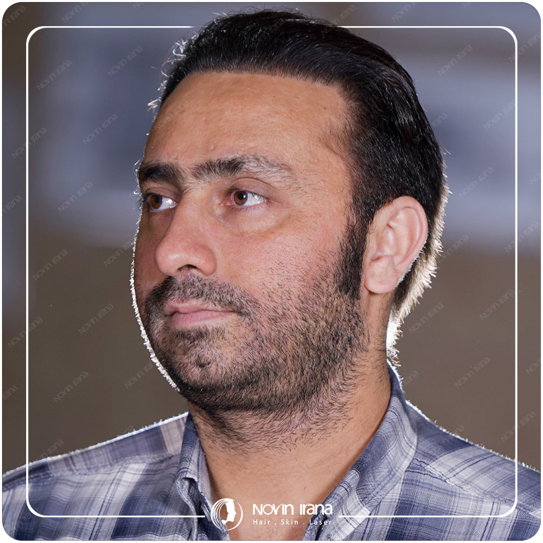 کاشت مو