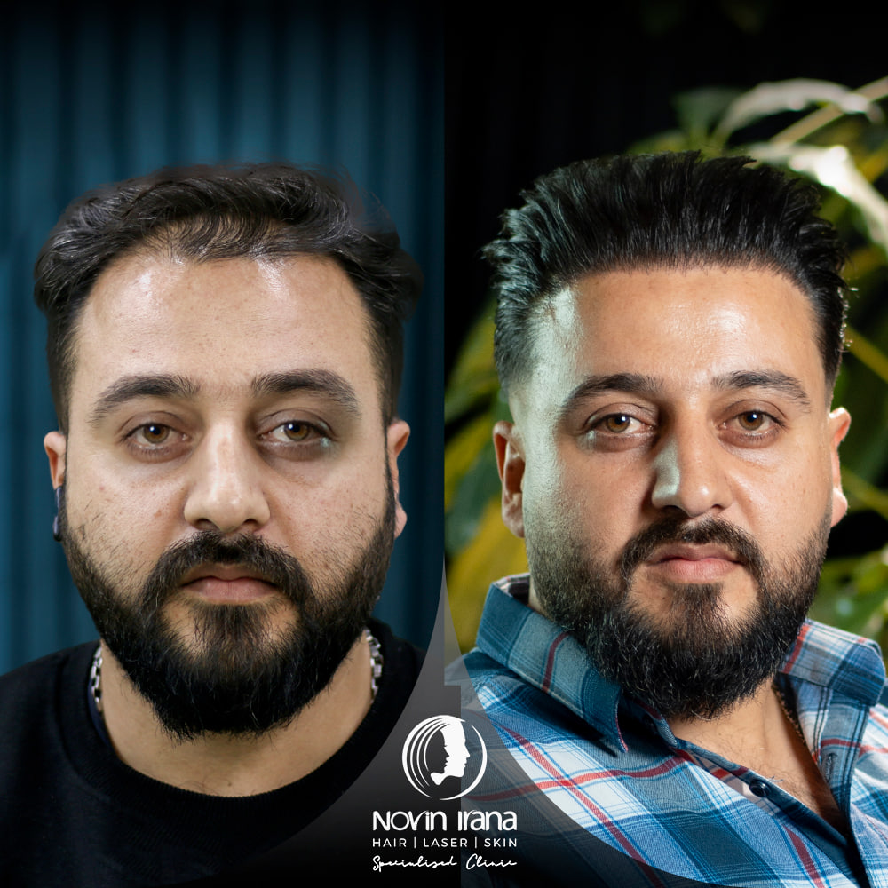 زراعة الشعر