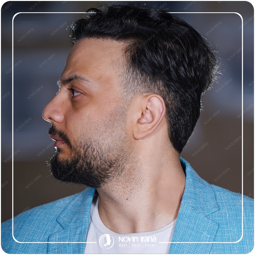 زراعة الشعر