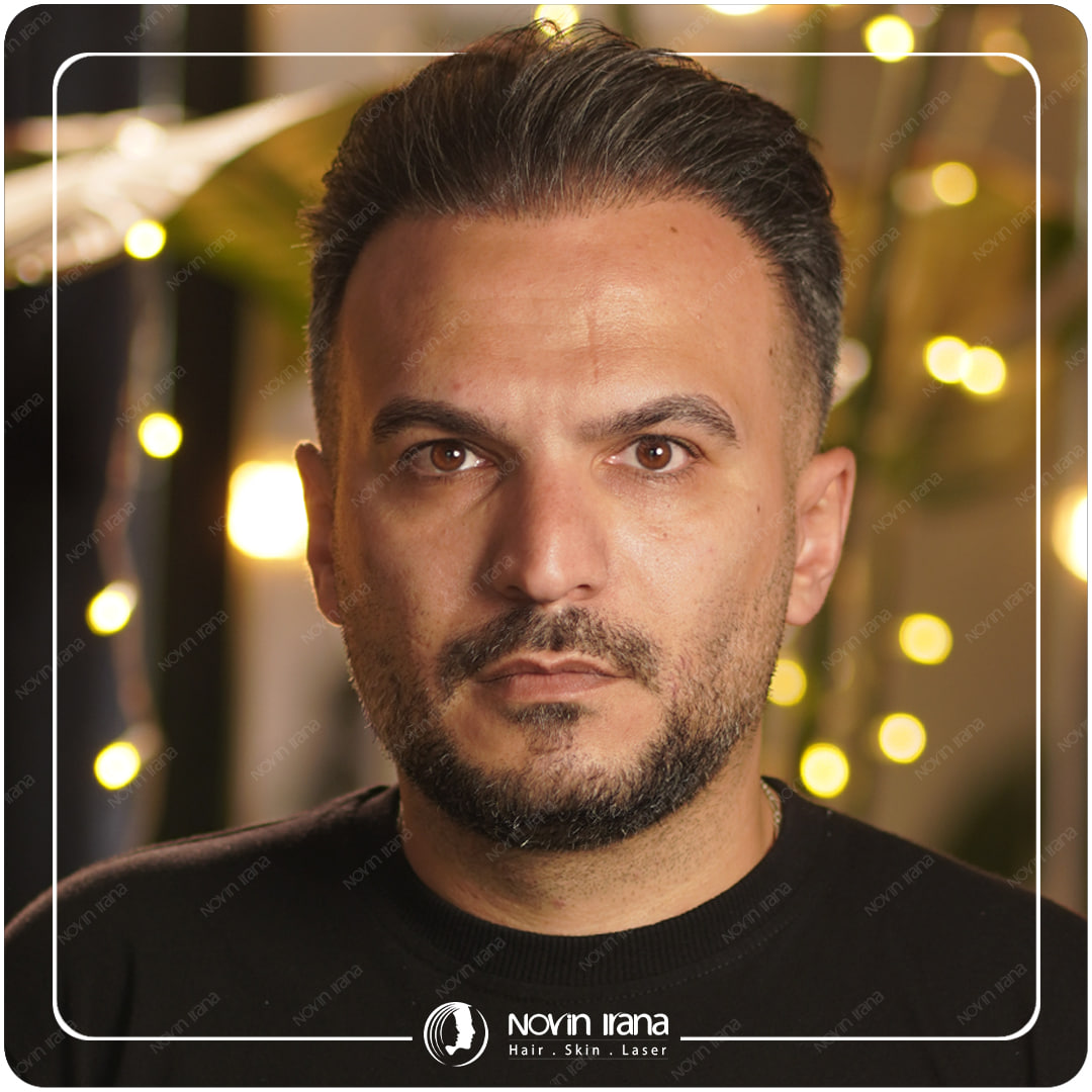 Hair Transplant