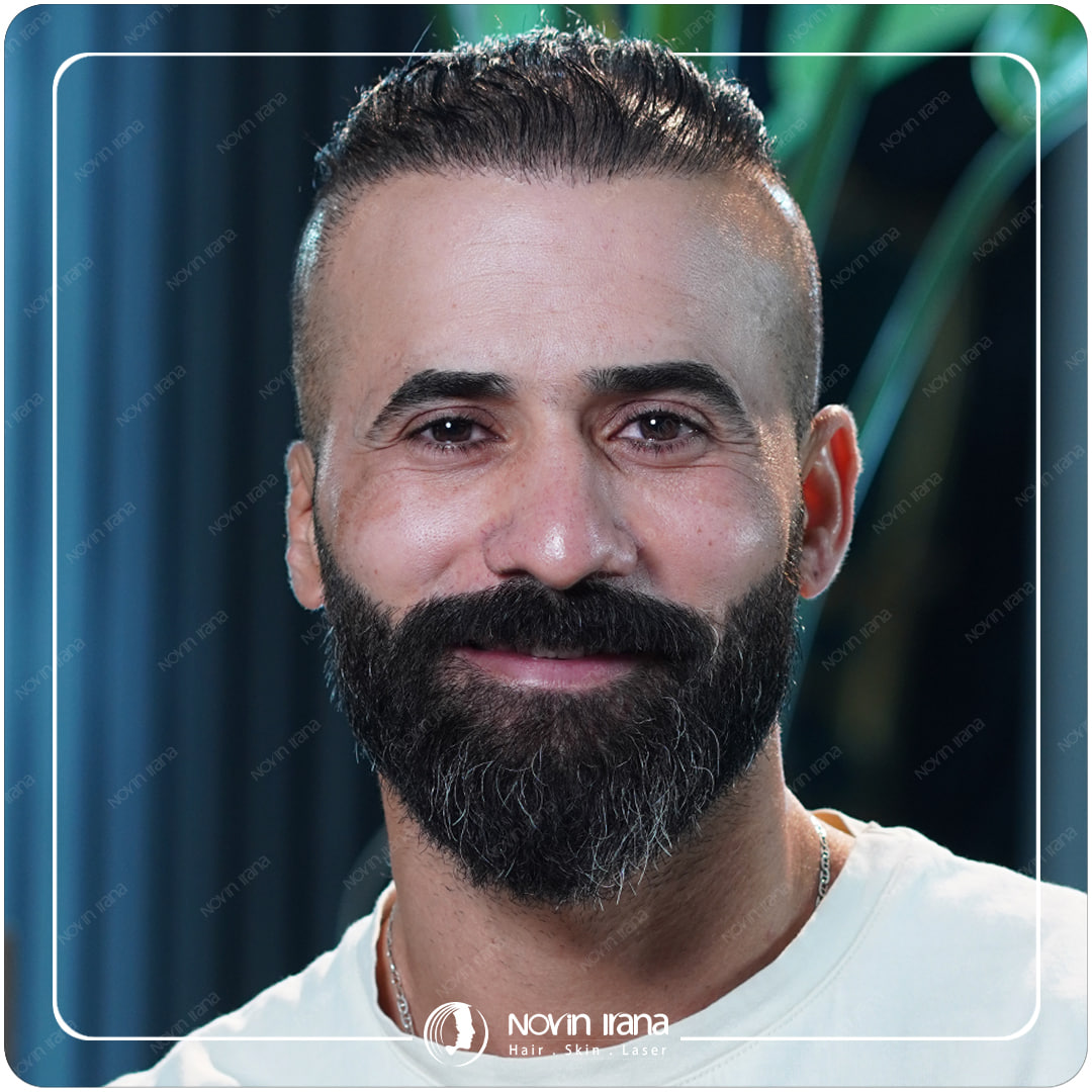 زراعة الشعر