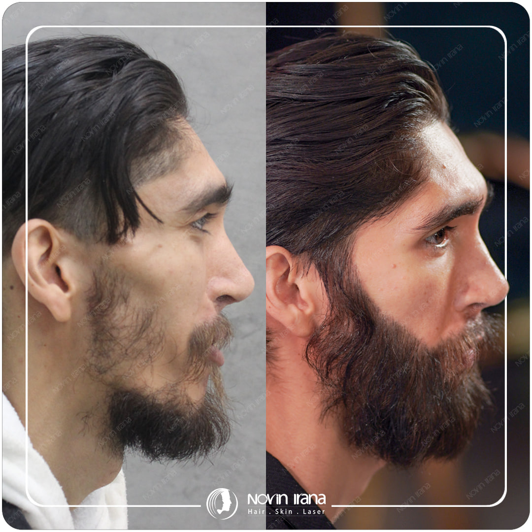 Hair Transplant