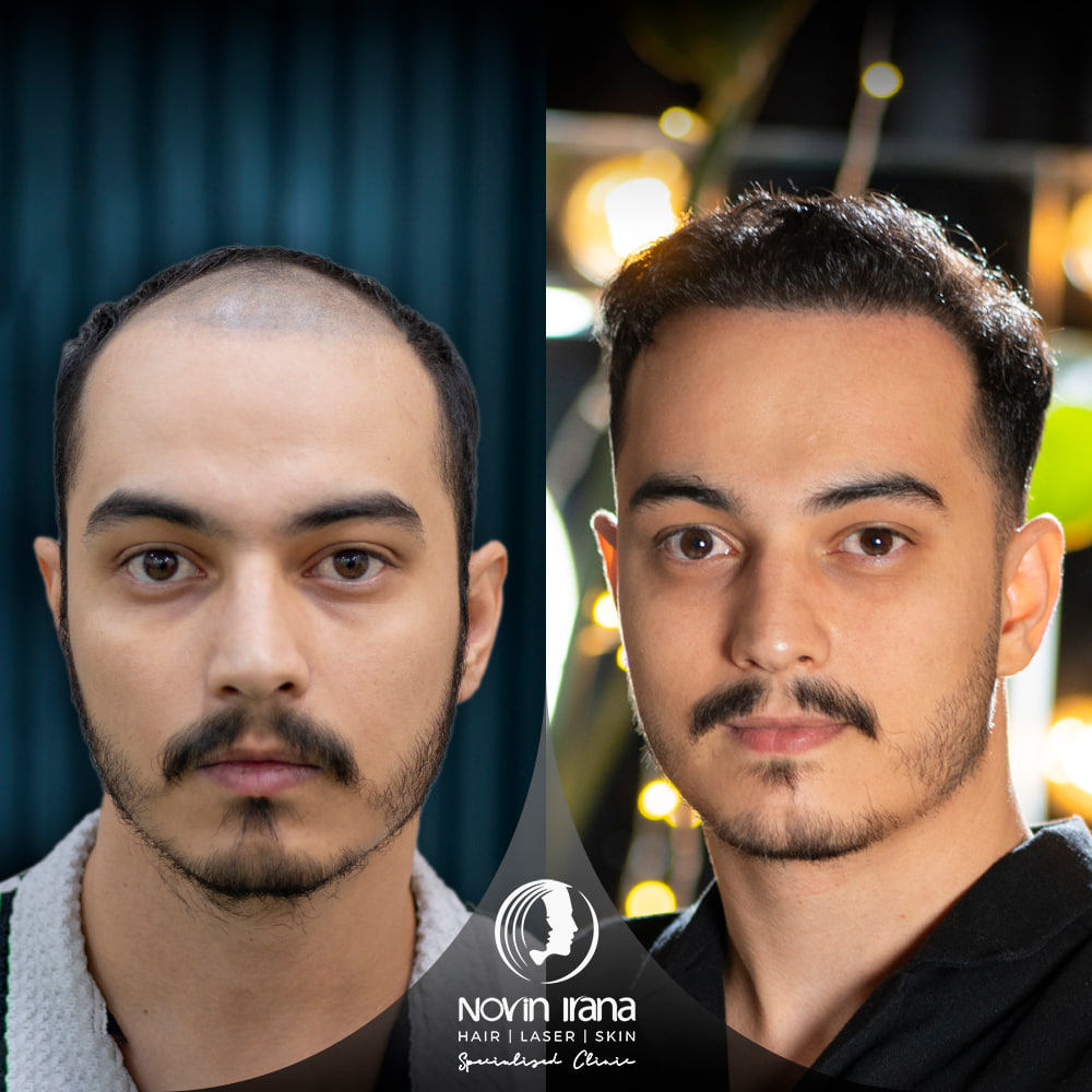 Hair Transplant