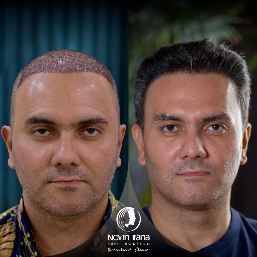 زراعة الشعر