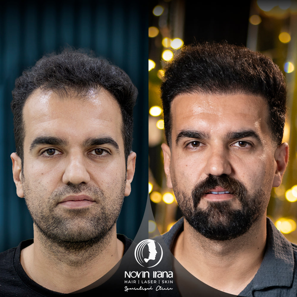 زراعة الشعر