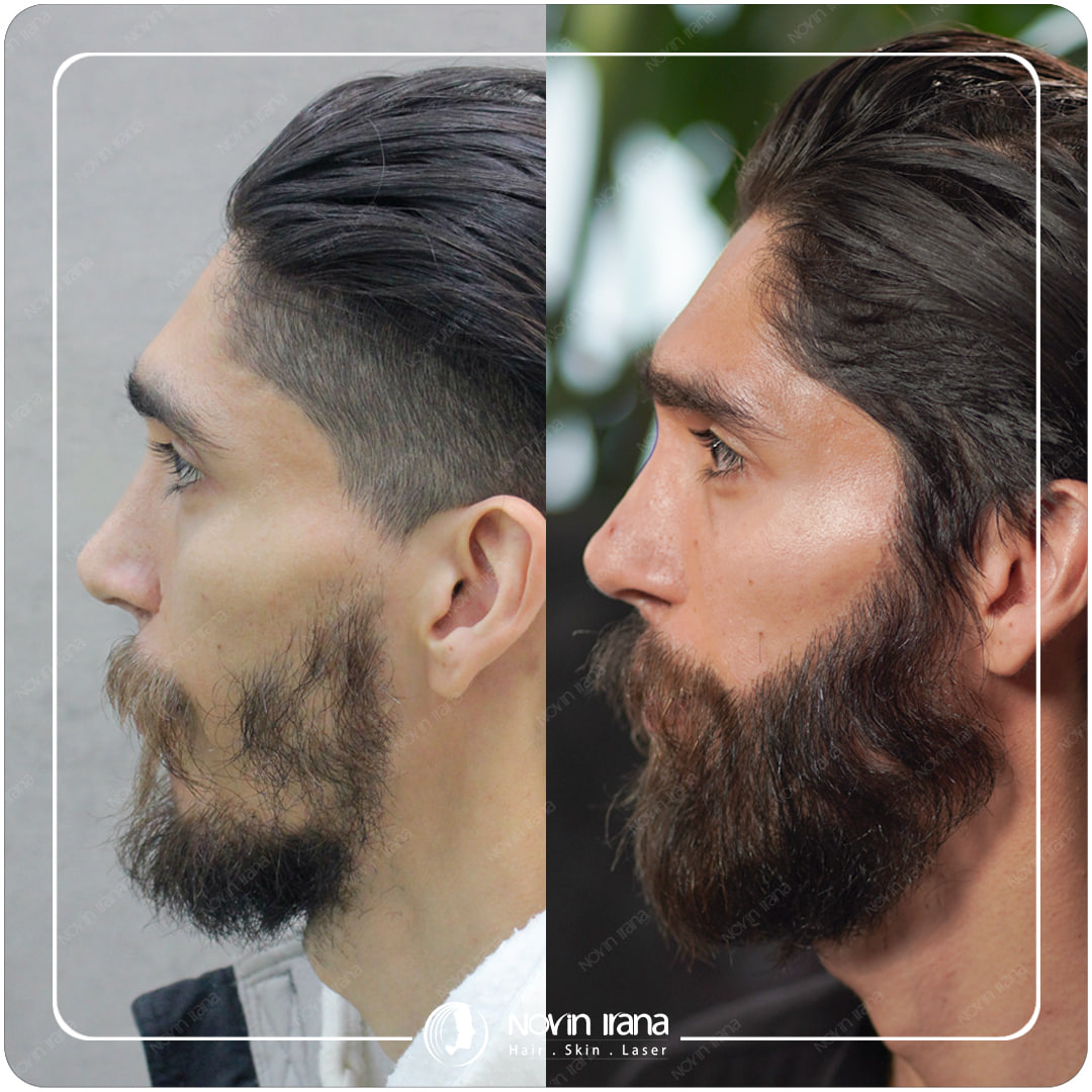 Hair Transplant
