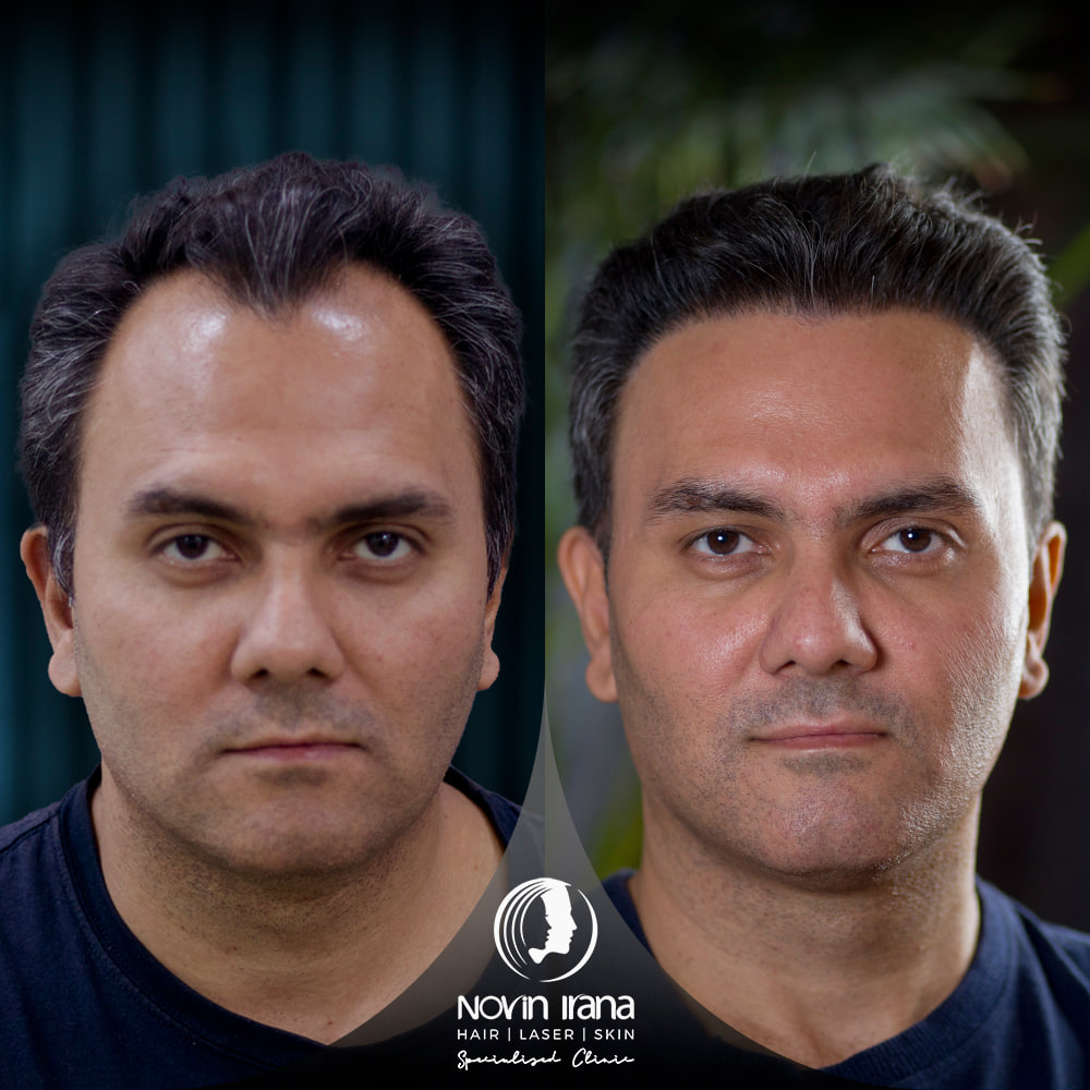 Hair Transplant