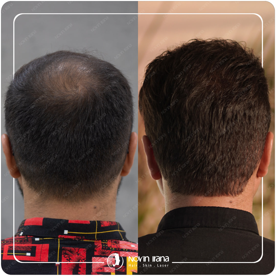 Hair Transplant
